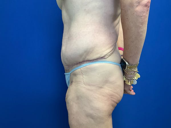 Tummy Tuck (Abdominoplasty) Before & After Gallery - Patient 299767 - Image 6