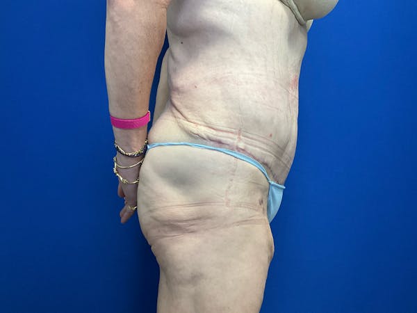 Tummy Tuck (Abdominoplasty) Before & After Gallery - Patient 299767 - Image 4
