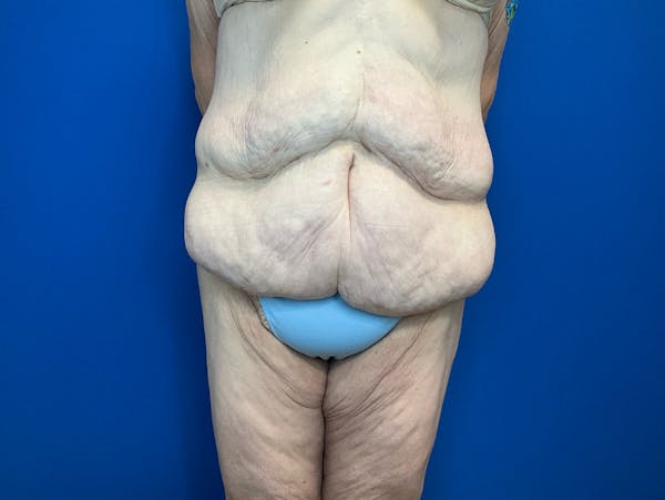 Tummy Tuck (Abdominoplasty) Before & After Gallery - Patient 299767 - Image 1