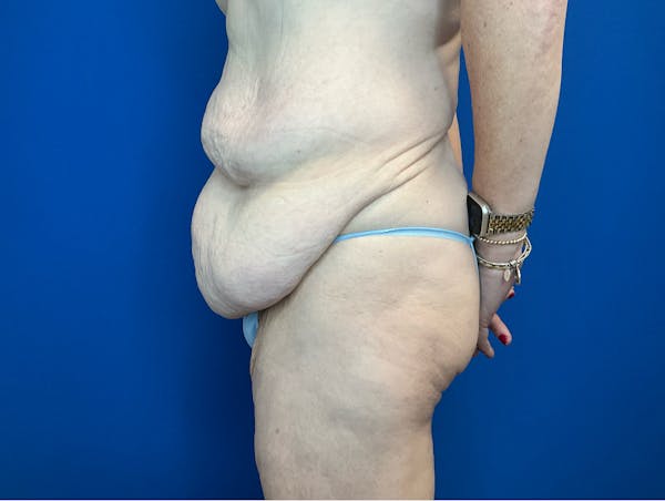 Tummy Tuck (Abdominoplasty) Before & After Gallery - Patient 299767 - Image 5