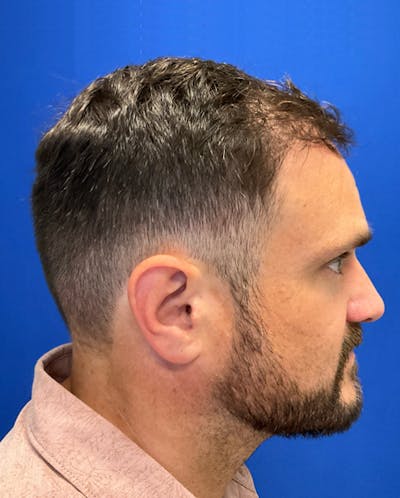 Hair Restoration Before & After Gallery - Patient 353381 - Image 6