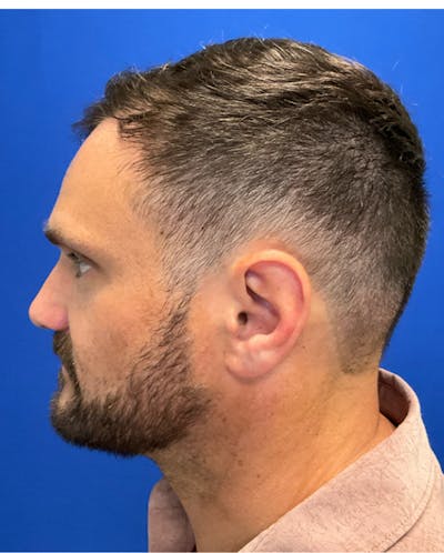 Hair Restoration Before & After Gallery - Patient 353381 - Image 4