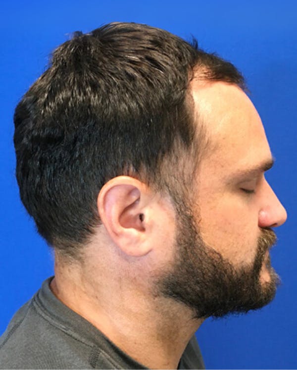 Hair Restoration Before & After Gallery - Patient 353381 - Image 5