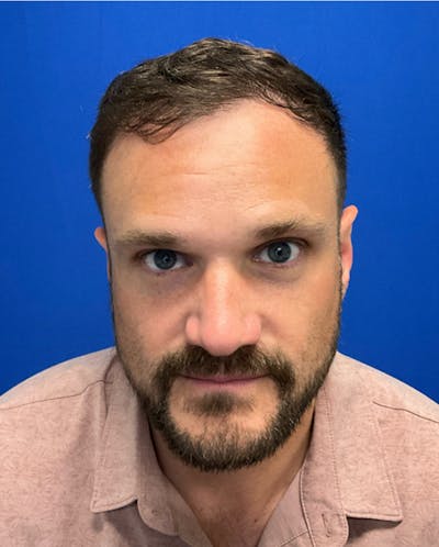 Hair Restoration Before & After Gallery - Patient 353381 - Image 2