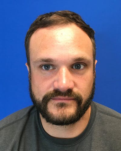 Hair Restoration Before & After Gallery - Patient 353381 - Image 1