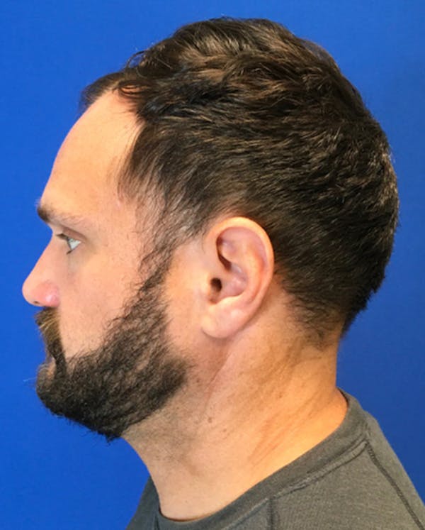 Hair Restoration Before & After Gallery - Patient 353381 - Image 3