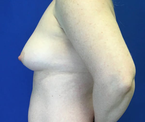 Breast Augmentation Before & After Gallery - Patient 406950 - Image 5