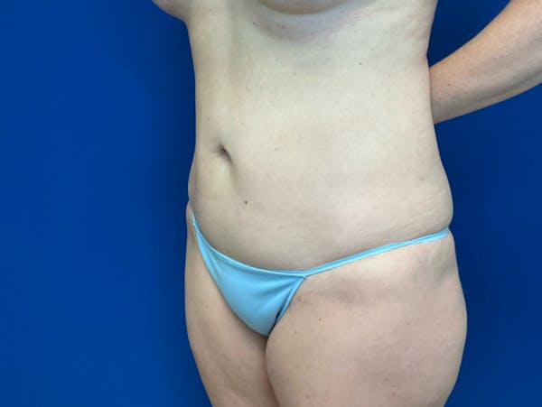 Liposuction Before & After Gallery - Patient 345945 - Image 4
