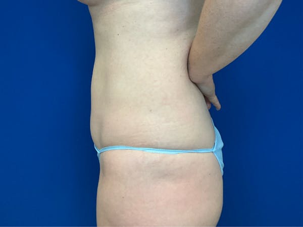 Liposuction Before & After Gallery - Patient 345945 - Image 6
