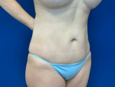 Liposuction Before & After Gallery - Patient 345945 - Image 8