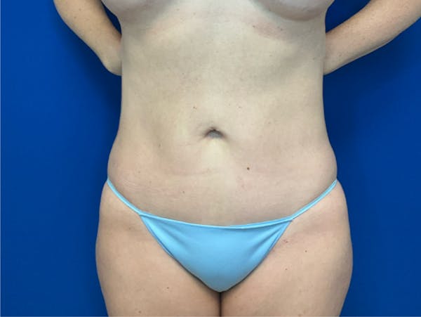 Liposuction Before & After Gallery - Patient 345945 - Image 2
