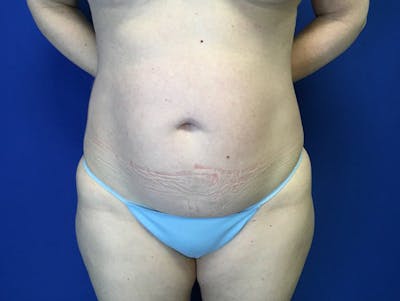 Liposuction Before & After Gallery - Patient 345945 - Image 1