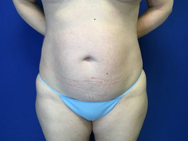 Liposuction Before & After Gallery - Patient 345945 - Image 1
