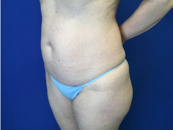 Liposuction Before & After Gallery - Patient 345945 - Image 3