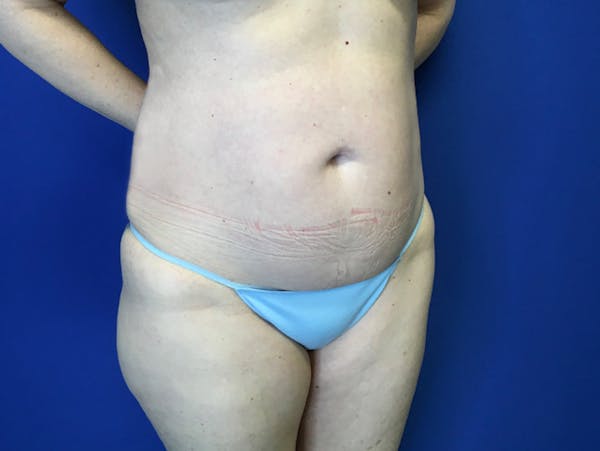Liposuction Before & After Gallery - Patient 345945 - Image 7