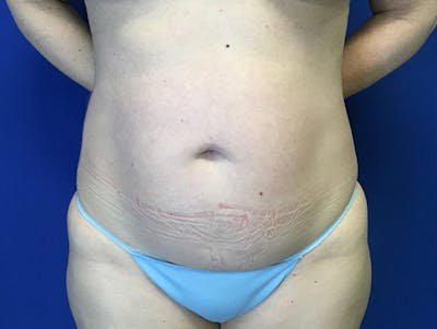 Liposuction Before & After Gallery - Patient 176281 - Image 1