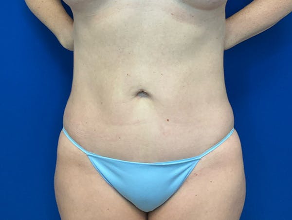 Liposuction Before & After Gallery - Patient 176281 - Image 2