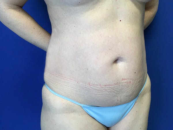 Liposuction Before & After Gallery - Patient 176281 - Image 3