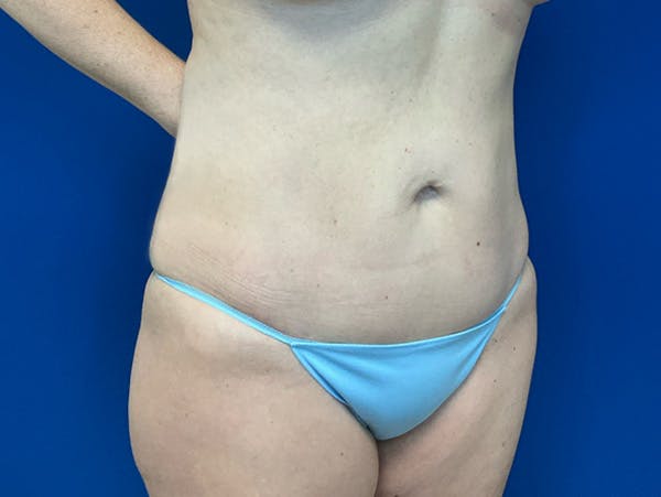 Liposuction Before & After Gallery - Patient 176281 - Image 4