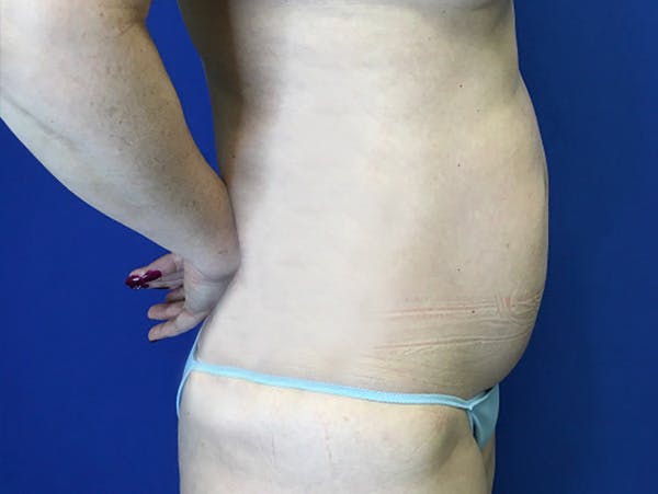 Liposuction Before & After Gallery - Patient 176281 - Image 5