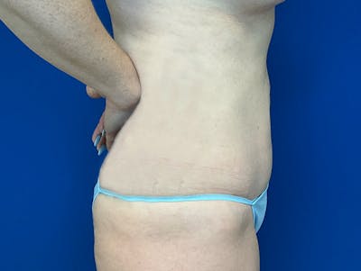 Liposuction Before & After Gallery - Patient 176281 - Image 6