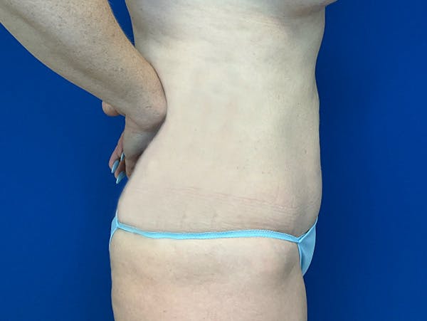 Liposuction Before & After Gallery - Patient 176281 - Image 6