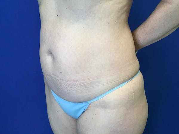 Liposuction Before & After Gallery - Patient 176281 - Image 7