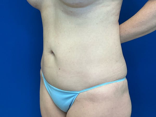Liposuction Before & After Gallery - Patient 176281 - Image 8