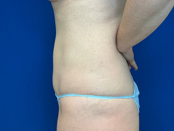 Liposuction Before & After Gallery - Patient 176281 - Image 10