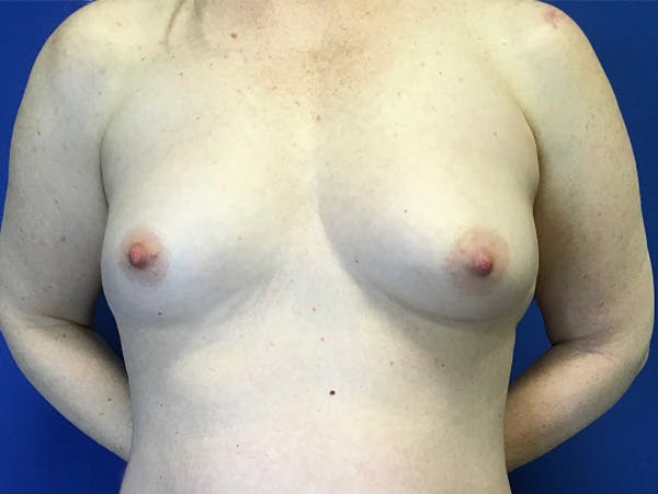 Breast Augmentation Before & After Gallery - Patient 790971 - Image 1