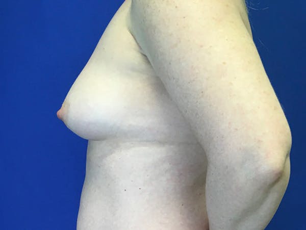 Breast Augmentation Before & After Gallery - Patient 790971 - Image 9