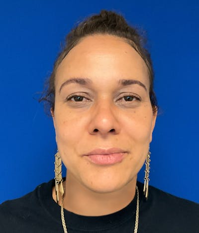 Rhinoplasty Before & After Gallery - Patient 426400 - Image 4