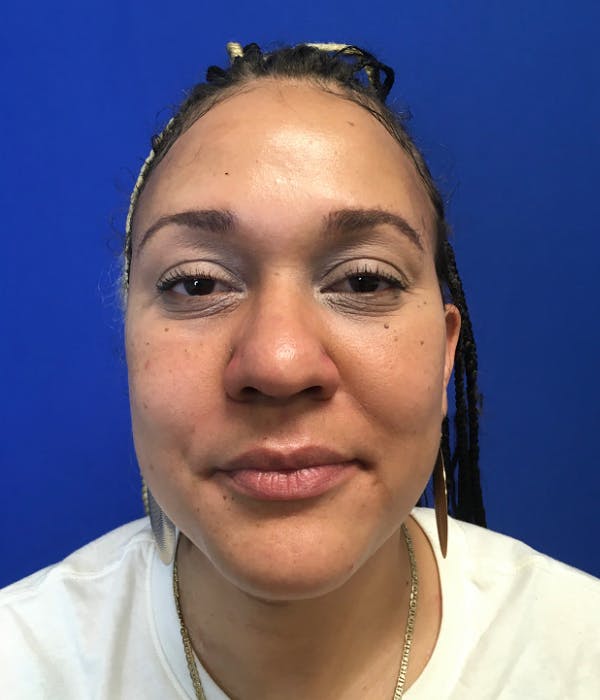 Rhinoplasty Before & After Gallery - Patient 426400 - Image 3