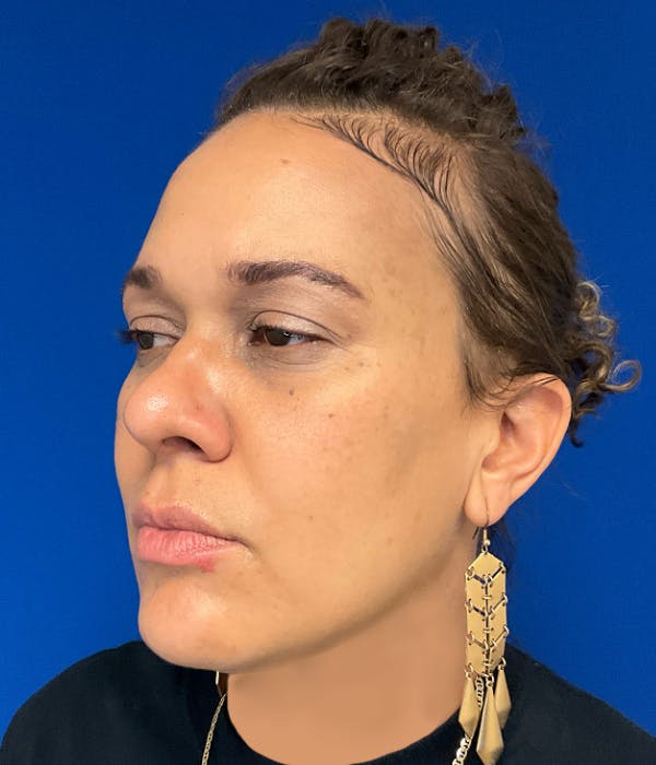 Rhinoplasty Before & After Gallery - Patient 426400 - Image 6