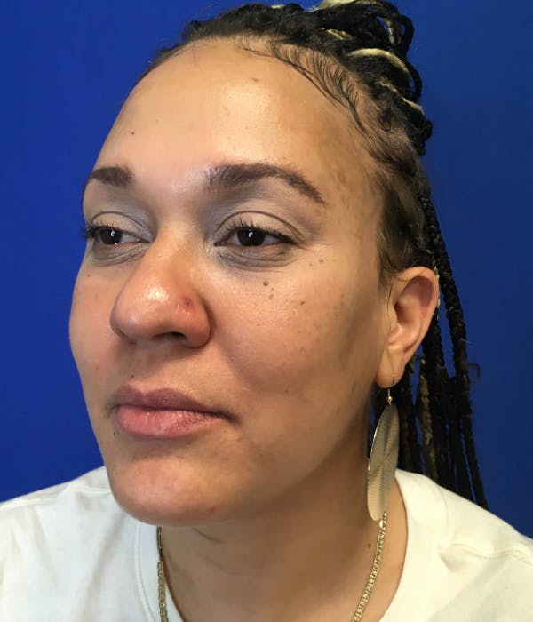 Rhinoplasty Before & After Gallery - Patient 426400 - Image 5