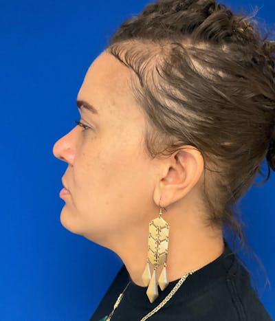 Rhinoplasty Before & After Gallery - Patient 426400 - Image 2