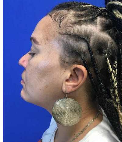 Rhinoplasty Before & After Gallery - Patient 426400 - Image 1