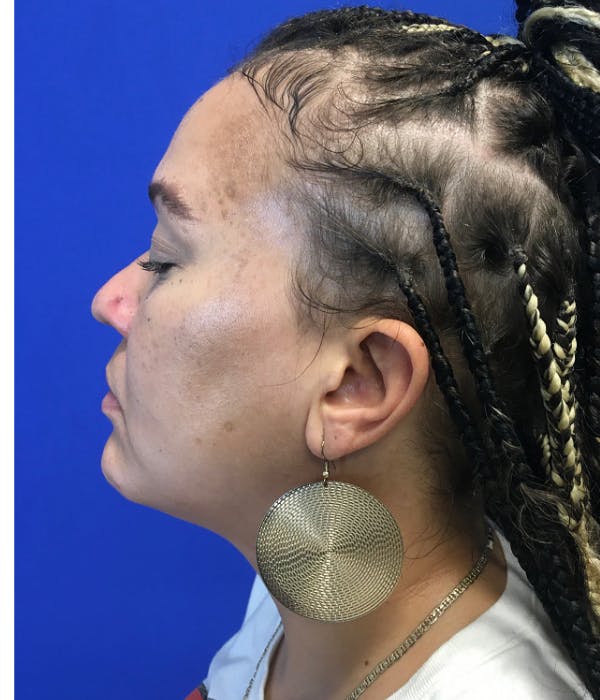 Rhinoplasty Before & After Gallery - Patient 426400 - Image 1