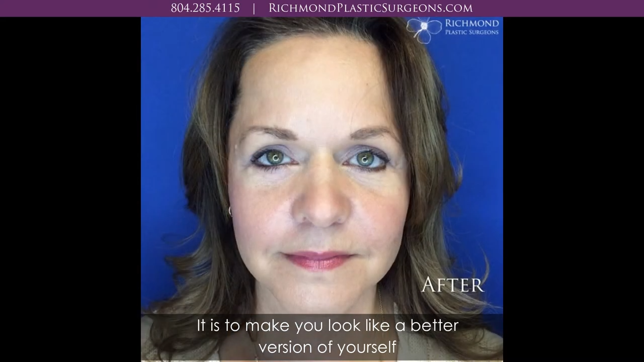 Woman's Facelift Results