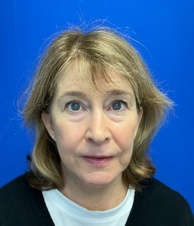 Neck Lift Before & After Gallery - Patient 137328 - Image 2