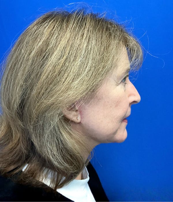 Neck Lift Before & After Gallery - Patient 137328 - Image 6