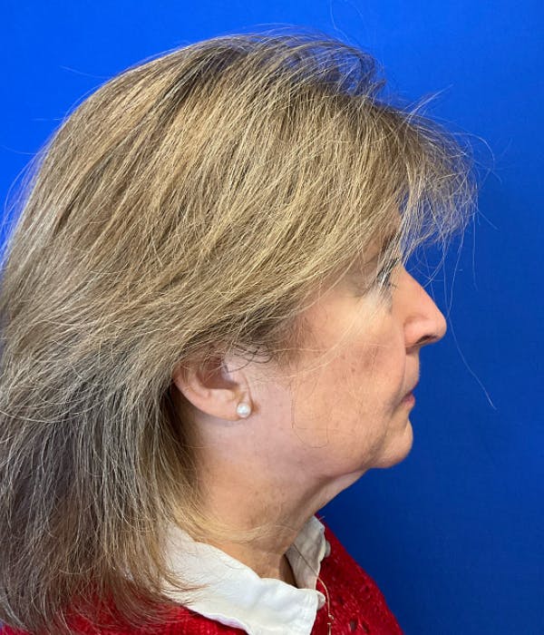 Neck Lift Before & After Gallery - Patient 137328 - Image 5