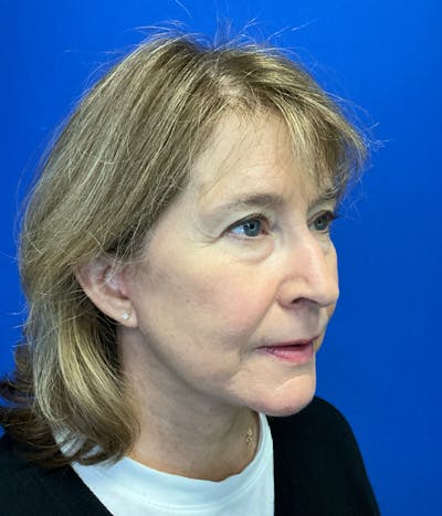 Neck Lift Before & After Gallery - Patient 137328 - Image 4