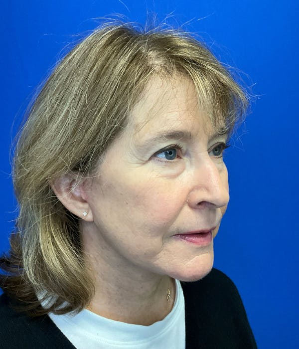 Neck Lift Before & After Gallery - Patient 137328 - Image 4