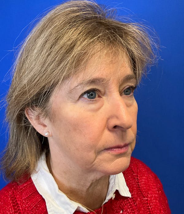 Neck Lift Before & After Gallery - Patient 137328 - Image 3