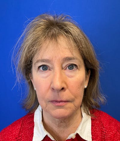 Neck Lift Before & After Gallery - Patient 137328 - Image 1