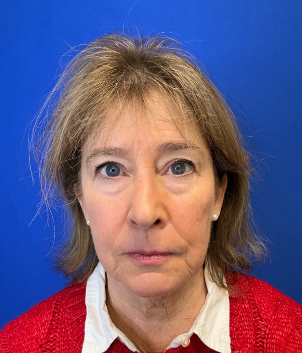 Neck Lift Before & After Gallery - Patient 137328 - Image 1