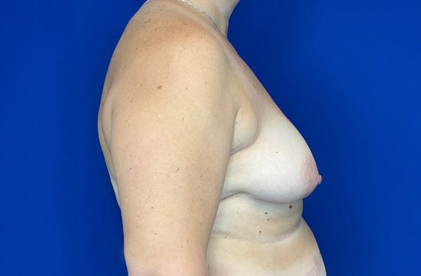 Breast DIEP Flap Reconstruction Before & After Gallery - Patient 144437 - Image 3