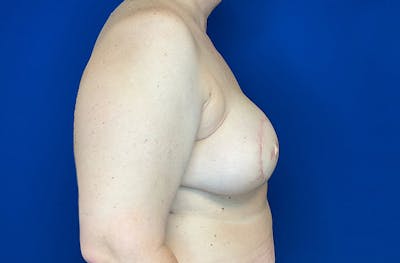 Breast DIEP Flap Reconstruction Before & After Gallery - Patient 144437 - Image 4