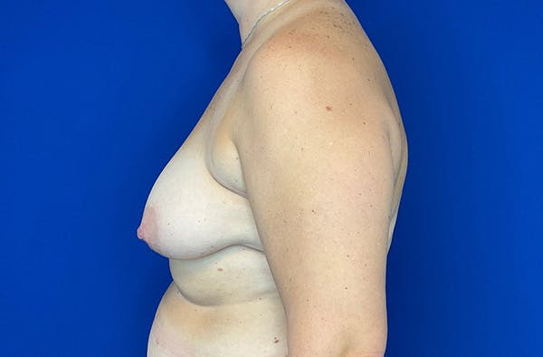 Breast DIEP Flap Reconstruction Before & After Gallery - Patient 144437 - Image 5